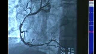 Cardiac Cath with Angioplasty [upl. by Stubstad]