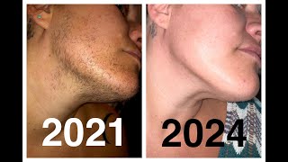 Results after 161 Hours of Electrolysis facial hair removal PCOS Hirsutism Excess Hair [upl. by Yrahcaz609]