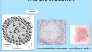 What is Sarcoidosis  Adam Morgenthau MD Mt Sinai Medical Center [upl. by Chiles]