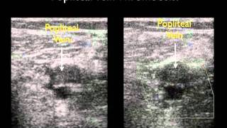 How To Deep Vein Thrombosis Detection with Ultrasound Part 2 Case Study Video [upl. by Langer]