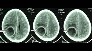 Radiologic features of Brain Abscess [upl. by Sakul]