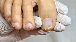 How to cut out a separated nail onycholysis [upl. by Banquer713]