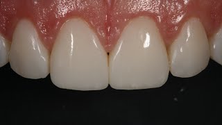 Resin Veneering and Freehand Diastema Closure [upl. by Myrvyn231]