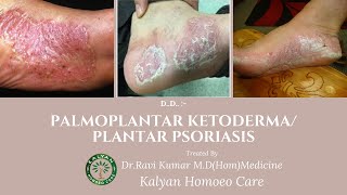 Case of palmoplantar ketoderma plantar psoriasis treatmentampmedicine in HomeopathyDrRavi kumar MD [upl. by Avahc]