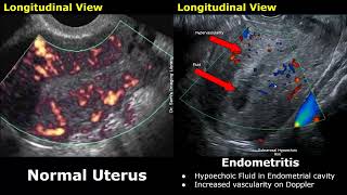 Uterus amp Adnexa Ultrasound Normal Vs Pelvic Inflammatory Disease PID Images  Gynecological USG [upl. by Annie329]