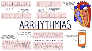 Understanding Arrhythmias [upl. by Joshia]