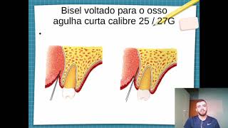 Tecnica de anestesia para el Nervio alveolar inferior [upl. by Rez]