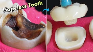 IMPOSSIBLE Restoration Of Tooth Caries  Amazing Before And After [upl. by Marilyn]