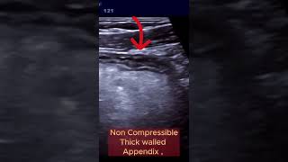 When Appendix becomes Infected and Complicated ultrasound appendicitis intestine [upl. by Sherrer836]