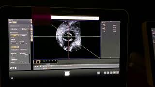 How to use Multiplanar Reconstruction MPR on a Phillips EPIQ echocardiogram [upl. by Notxam]