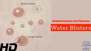 Water Blisters Unveiled Causes Treatment and Prevention [upl. by Caty551]