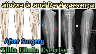 tibia fracture recovery exercises after surgery  tibial fracture exercises tibia x rays  in hindi [upl. by Wyon]