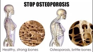 Osteoporosis animation 3d [upl. by Takeshi]