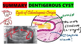 Dentigerous cyst  10 minute SUMMARY  Histopathology  Clinical features  Radiographic features [upl. by Chasse]