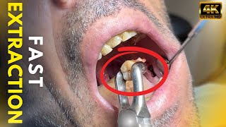 Gentle and Fast Lower Wisdom Tooth Extraction 4K [upl. by Hannej]