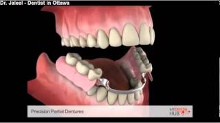 Prosthodontics  Precision Partial Denture  Ottawa Dentist [upl. by Aramoy]