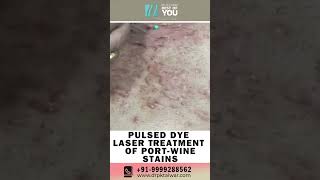 Pulsed Dye Laser Treatment of Port Wine Stains  Birthmark Removal with Laser  Dr PK Talwar [upl. by Suirauqed53]