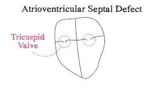 Atrial Septal Defect  Defect Closure Procedure  Why Close the ASD  wwwCardiacClinicca [upl. by Aihsenrad]