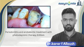 quotSingleVisit Restoration RCTand photodynamic therapy 630ūm quotTherapy for 7mm Deep Periodontitis [upl. by Ahsaetan735]