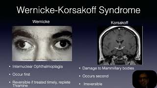 Wernickes Korsakoff syndrome [upl. by Laval583]