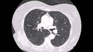 Spiculated lung tumor in background of emphysema [upl. by Enomad]