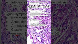 Acute interstitial nephritis [upl. by Farwell]