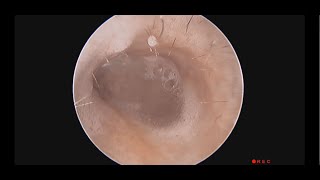 Cleaning Infected Mastoidectomy Cavity [upl. by Fidela743]