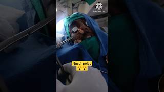 nasal polypent noseshortsshortvideo ytshorts remove [upl. by Tarrance]