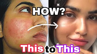 WATCH THIS to REPAIR your SKIN BARRIER without VISITING the Dermatologist✨soothe  repair skincare [upl. by Behlke]