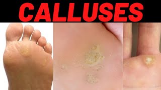 CALLUS Causes Symptoms Treatment Prevention [upl. by Karlene]