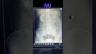 Intra venous urogram  pyelogram  radiological xray medicalimaging doctor anatomy [upl. by Kaile983]