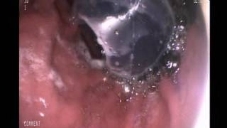 spatz 3 intragastric balloon insertion by professor nashwan altaee [upl. by Hsan]