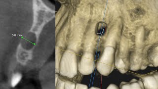 An Asymptomatic Odontogenic ToothRelated Cyst Surgical and Endodontic Management [upl. by Comfort]