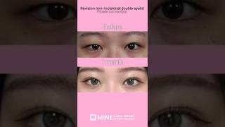 Droopy eyes correction ptosis shorts ptosis beforeandafter [upl. by Lirpa328]