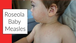 ROSEOLA  BABY MEASLES  SIGNS amp SYMPTOMS  RASH [upl. by Tenn]