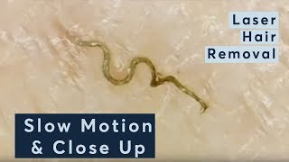 Laser Hair Removal In Slow Motion amp Close Up [upl. by Adnac]