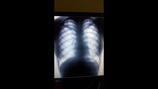 Pleural Drainage Плевральный дренаж [upl. by Ettevets]