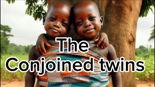 The conjoined Twins They were joined together by their bodies from birth africanstories story [upl. by Kall950]