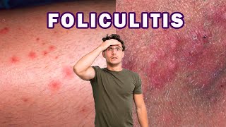 CÓMO ELIMINAR LA FOLICULITIS INFECCIOSA  BACTERIANA [upl. by Egon]