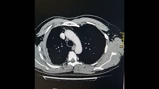 Small hydropneumothorax on right side with pleural cortication [upl. by Philbrook297]