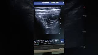 Appendicitis with formation lumpultrasonography sonography ultrasound video viralvideo [upl. by Theresina856]