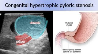 Pyloric stenosis step by step pylorus ultrasound Pyloric hypertrophic [upl. by Adachi]