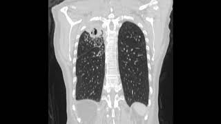 Chronic pulmonary aspergillosis after pulmonary tuberculosis [upl. by Rafaellle]