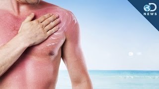 How Many Sunburns Can Cause Skin Cancer [upl. by Felton]