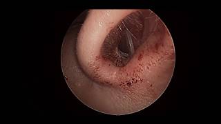 septal mucositis [upl. by Richmound]