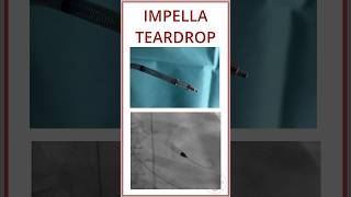 IMPELLA TEARDROP IN FLUOROSCOPY SCREW CONNECTION [upl. by Einneg]