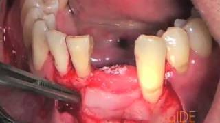 CV39 Extraction Site and Vertical Ridge Augmentation in the Lower Anterior PREVIEW [upl. by Mose622]