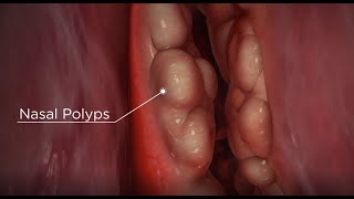 Nasal Polyps diagnosis and treatment options [upl. by Dyana141]