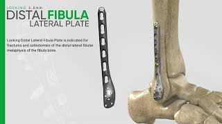 Zimed  Locking Distal Lateral Fibula Plate [upl. by Allmon]