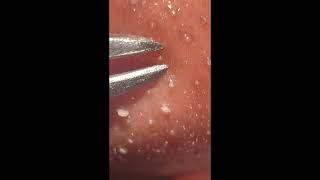 NOSE BLACKHEAD amp PIMPLE GOLDMINE [upl. by Hoxie]